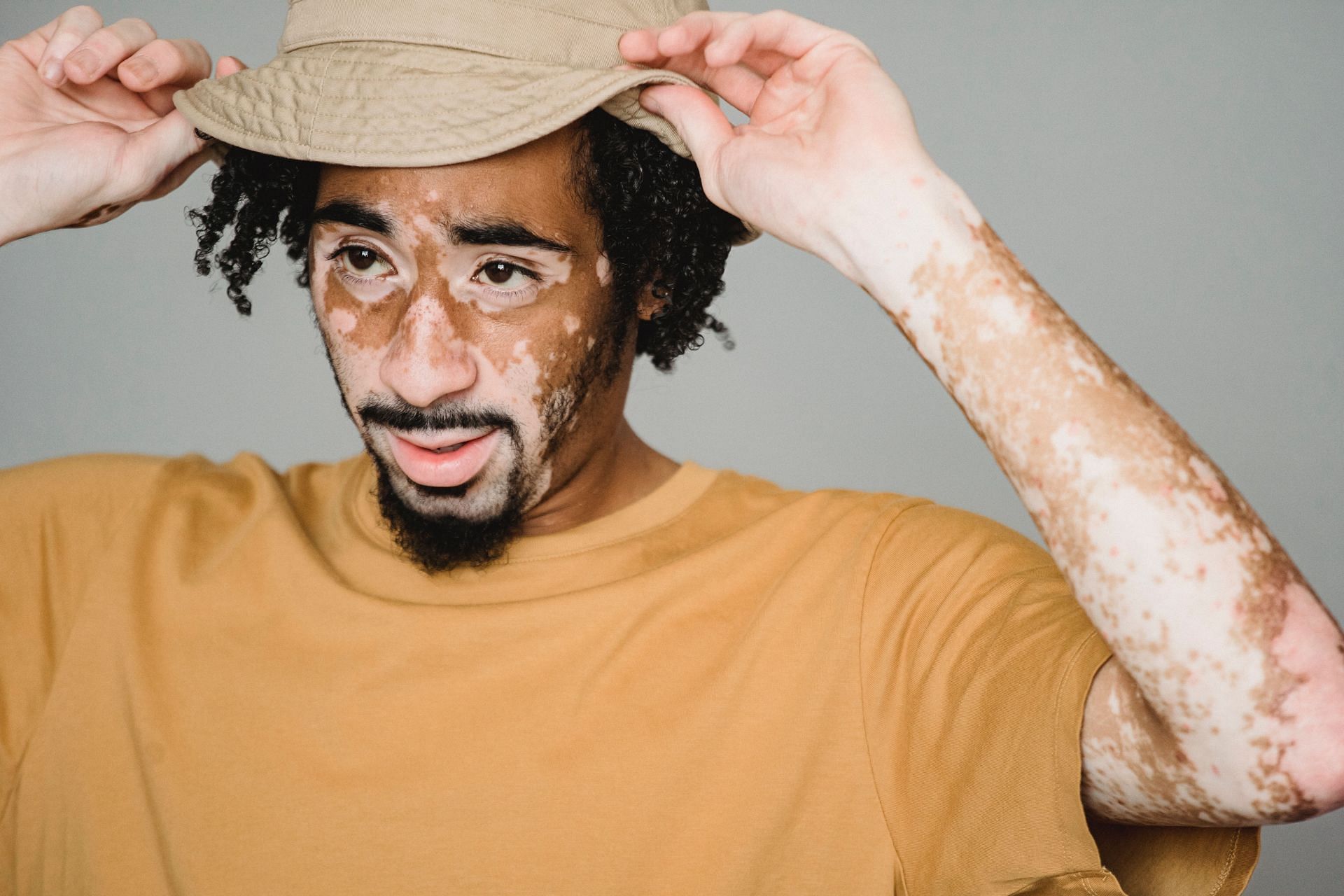 It's a skin condition that causes white patches on skin. (Image via Pexels/Armin)